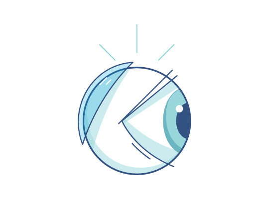 Illustration of contact lenses behind an eye ball